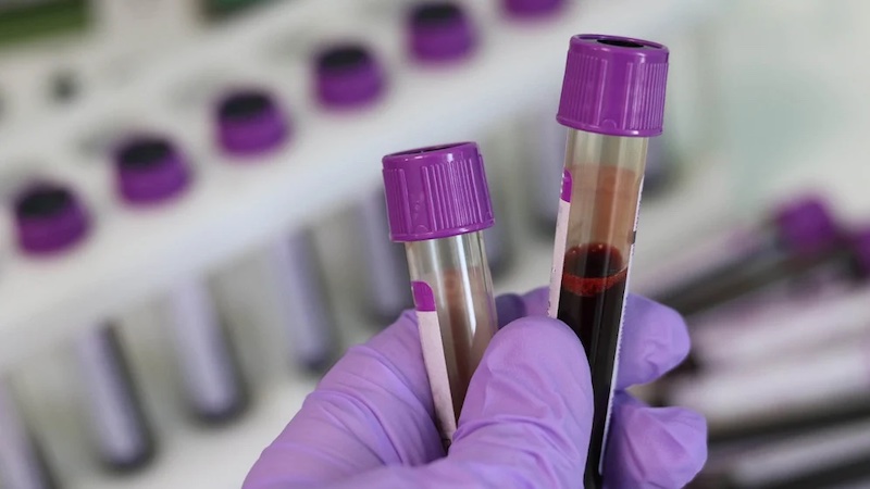 Blood samples are used in testing for prostate cancer. Research highlights genetic risks for African men and that early testing for prostate cancer is vital. Copyright: Tatiana from Pixabay