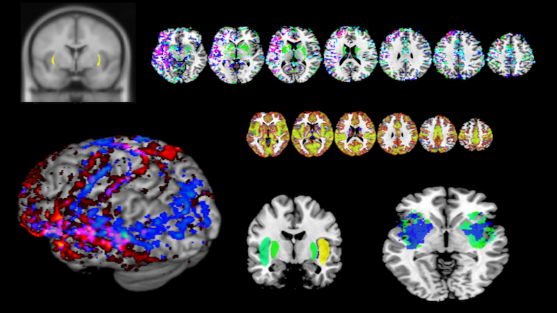 The brain’s claustrum activated when a person performs a complicated task. CREDIT: Brian Mathur, UMSOM