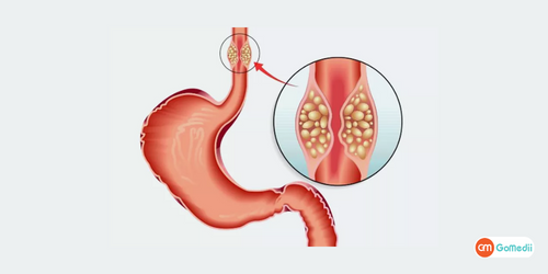 Lymphadenectomy For Esophageal Cancer Treatment, symptoms of esophageal cancer, causes of esophageal cancer, lymphadenectomy for esophageal cancer cost